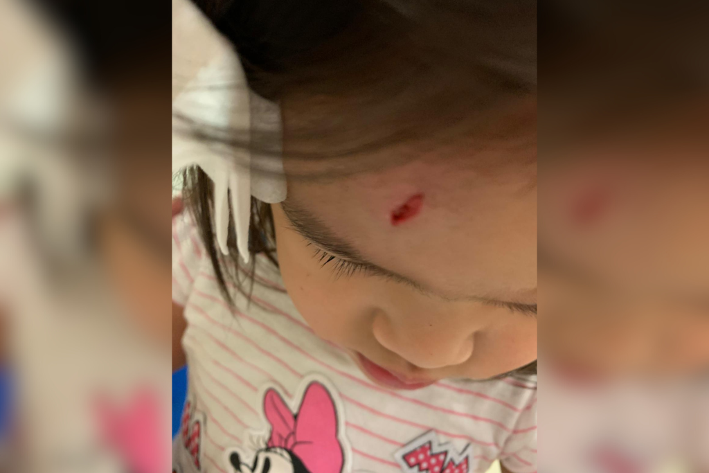 Eve Daughter Injury