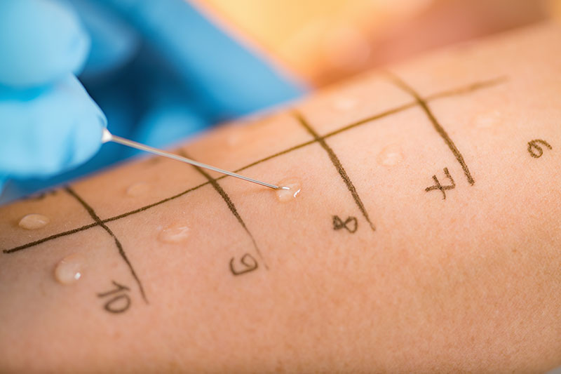 allergy-testing-on-skin-with-small-needle-prick